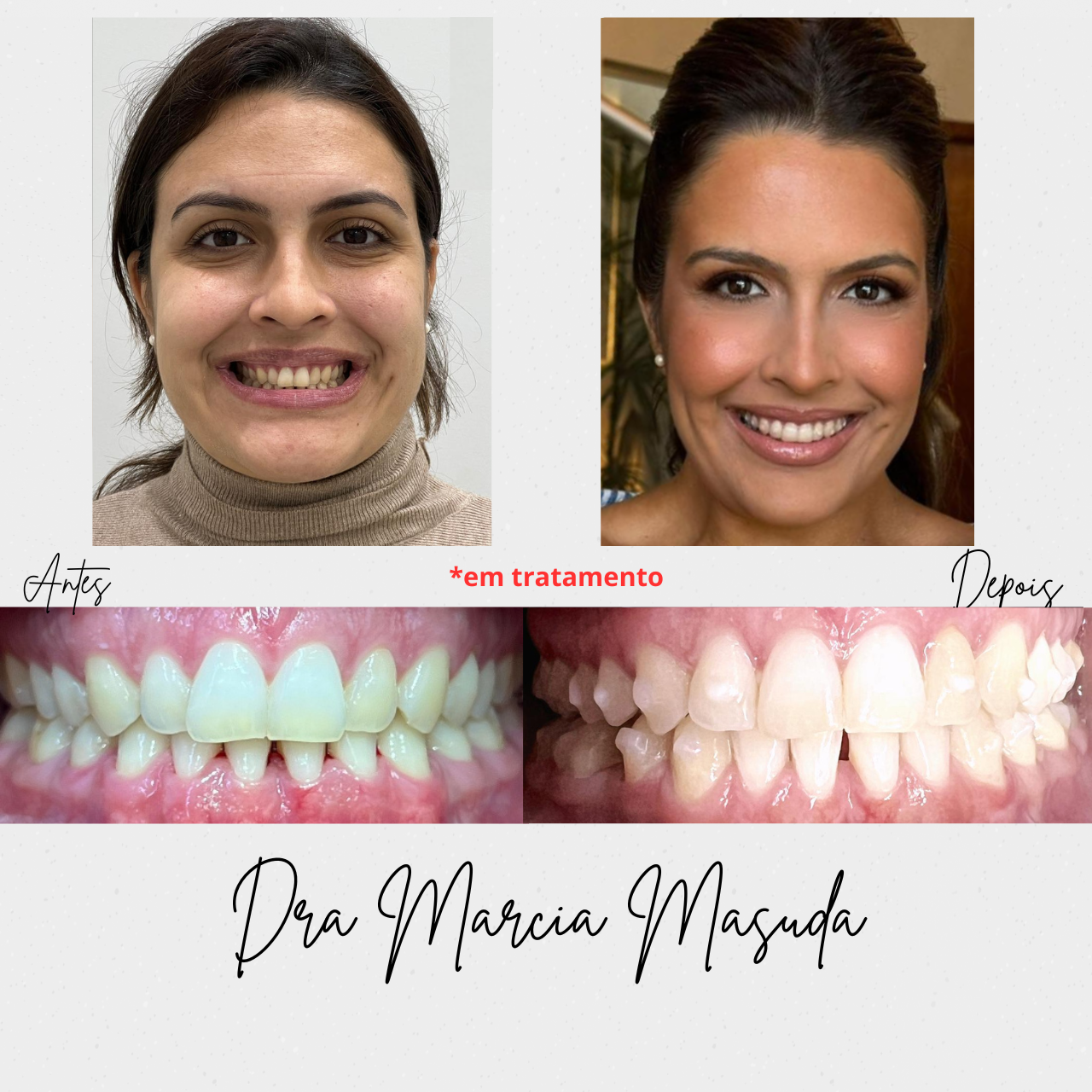 Resultado de tratamento Invisalign — antes e depois 1