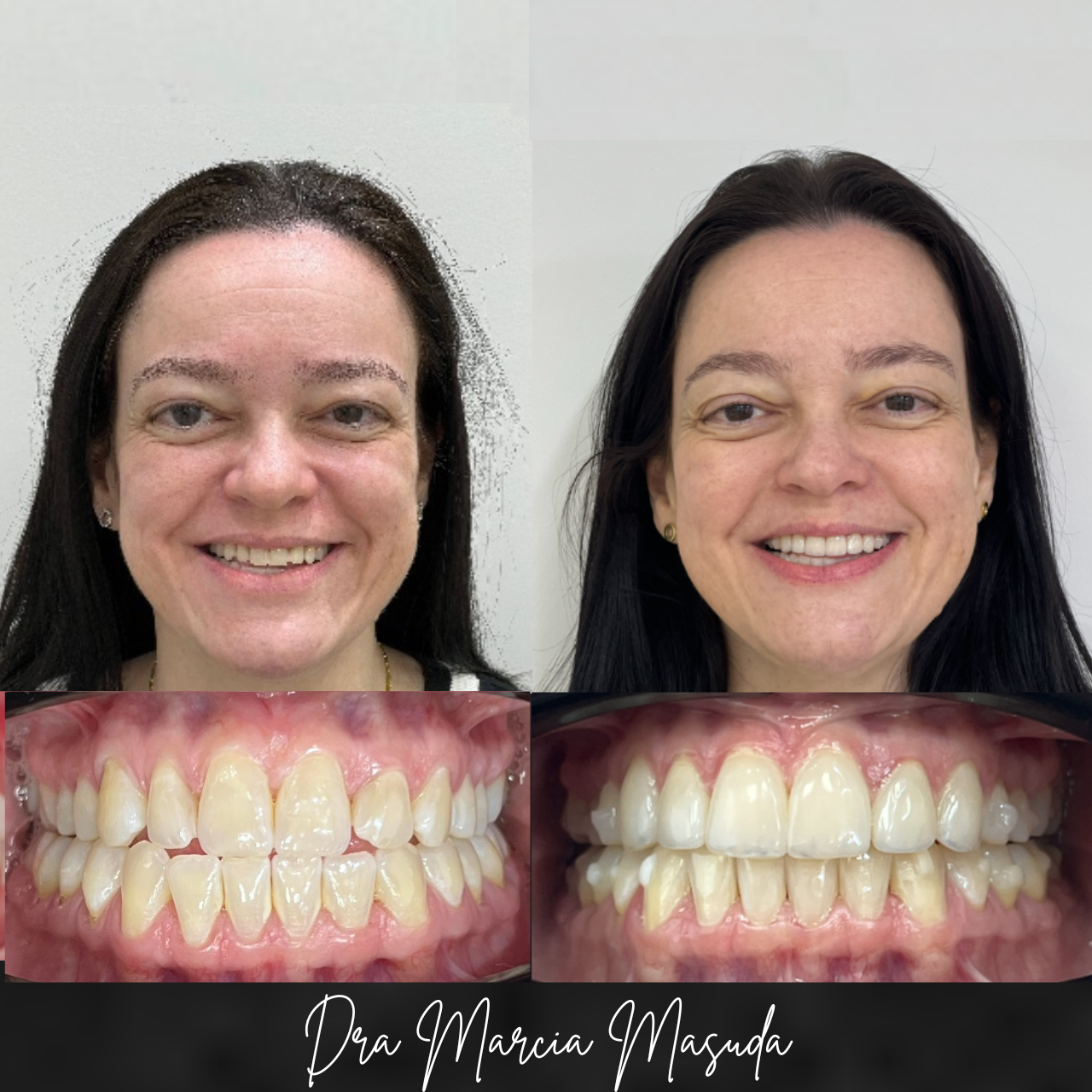Resultado de tratamento Invisalign — antes e depois 4