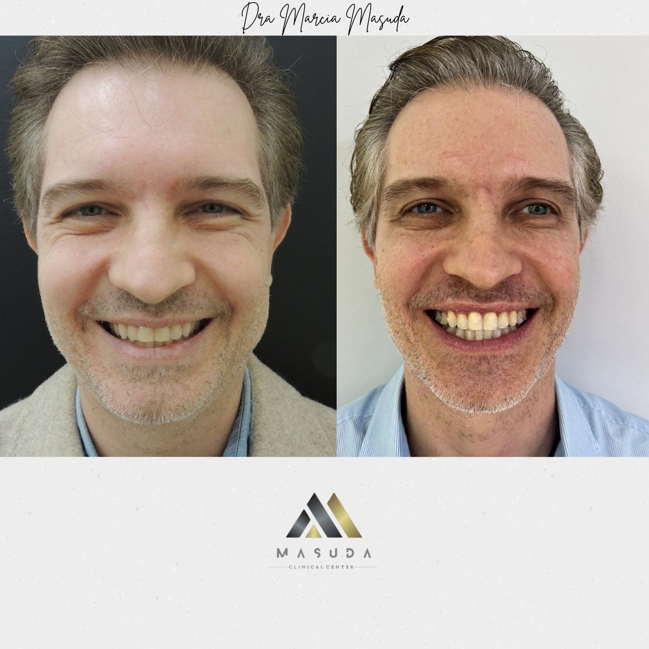 Resultado de tratamento Invisalign — antes e depois 3