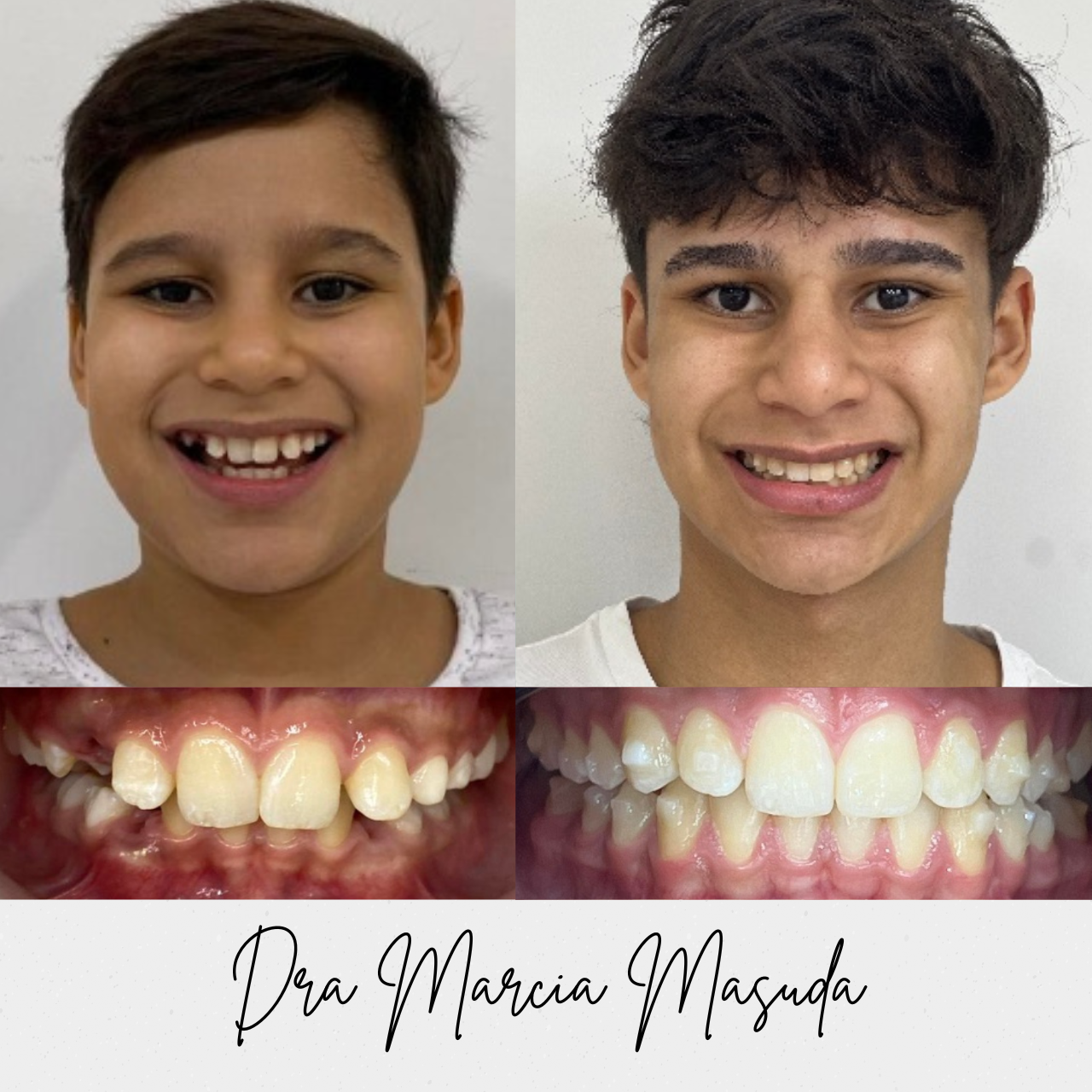 Resultado de tratamento Invisalign — antes e depois 2